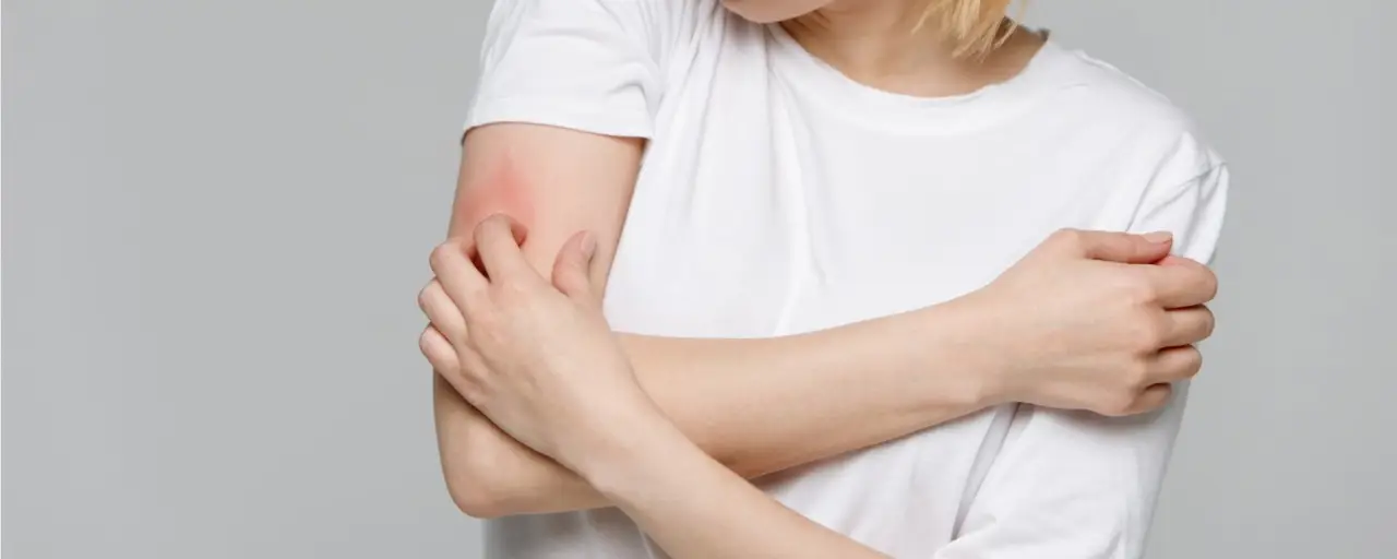 Pelle arrossata e prurito per lo stress? Ecco la crema che calma subito la dermatite